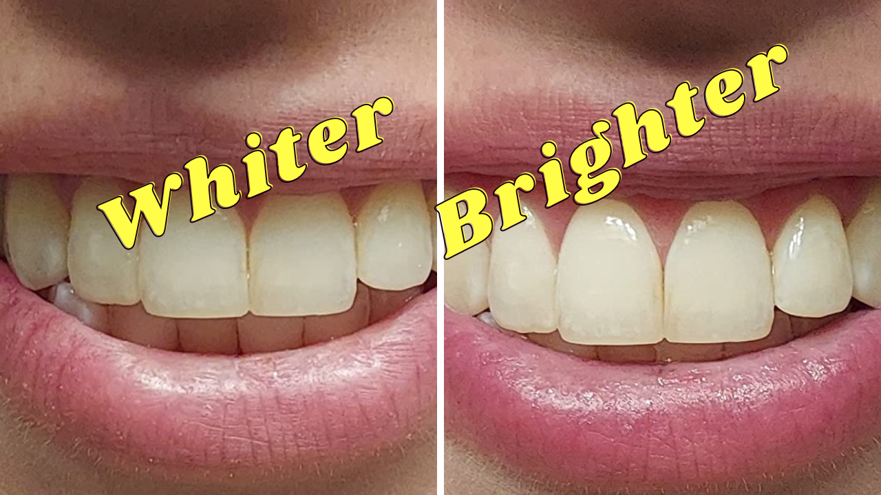 Purple Teeth Whitening: Reviewing 4 Products To Get That Pearly White Smile!